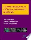 Lesiones Benignas De Esofágo, Estómago Y Duodeno